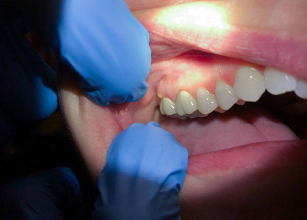 Best Broken or Cracked Tooth Emergency Dentist in Preston, TX