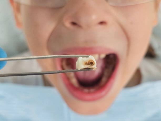 Best Emergency Dentist for Knocked-Out Tooth in Preston, TX